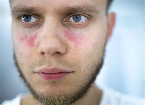 Kelebek hastalığı (Lupus) nedir? Nasıl tedavi edilir?