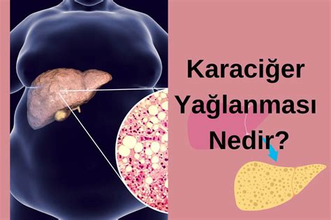 Karaciğer Yağlanması Belirtileri Nelerdir?